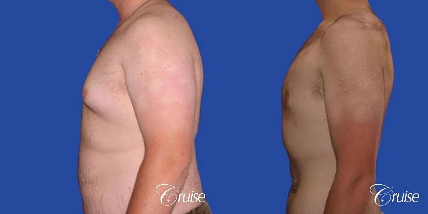 Gynecomastia Before & After