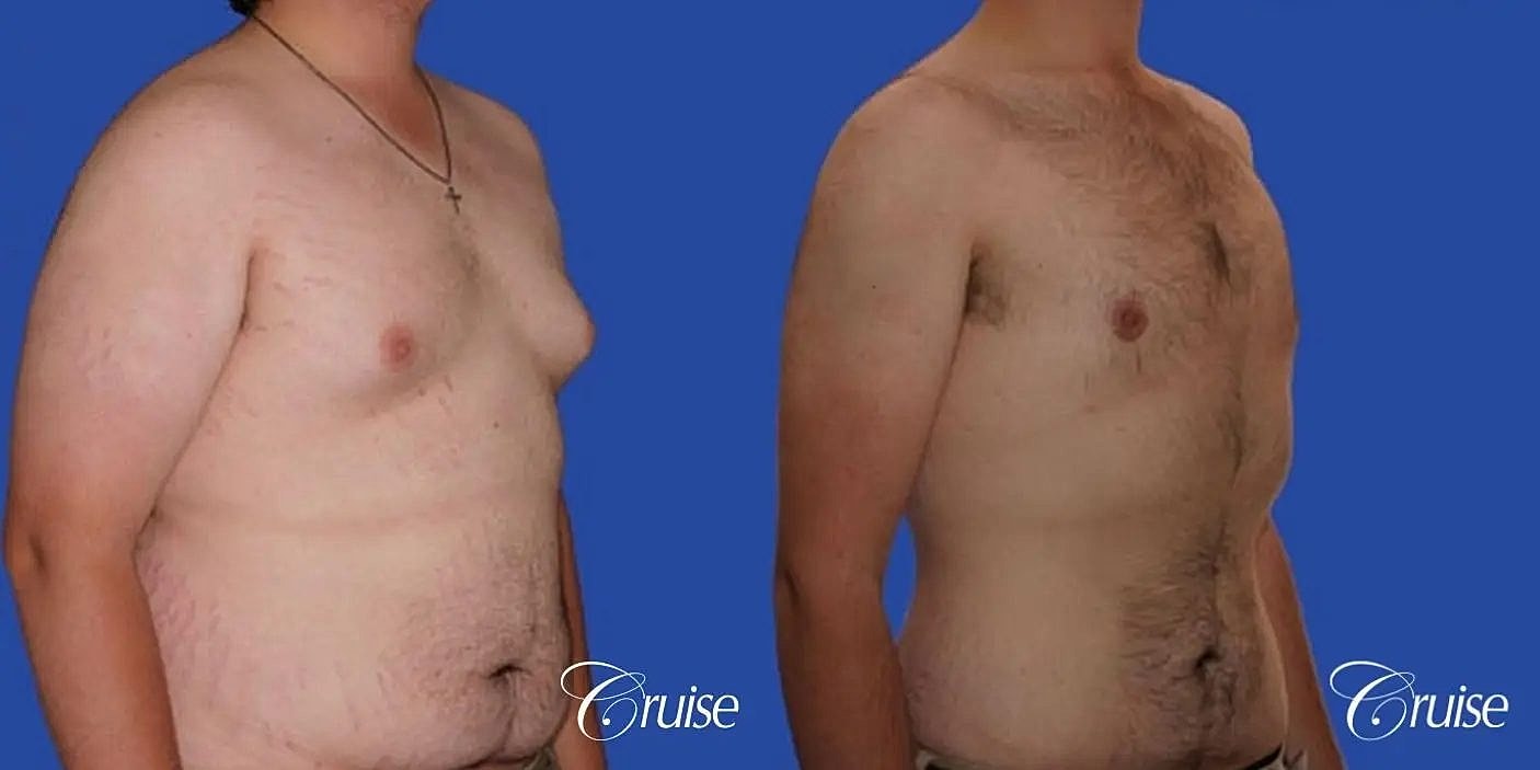 Gynecomastia Before & After
