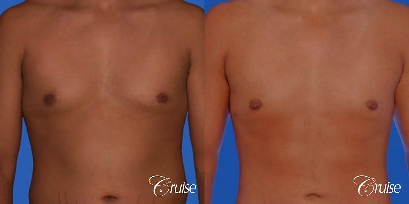 Gynecomastia Before & After