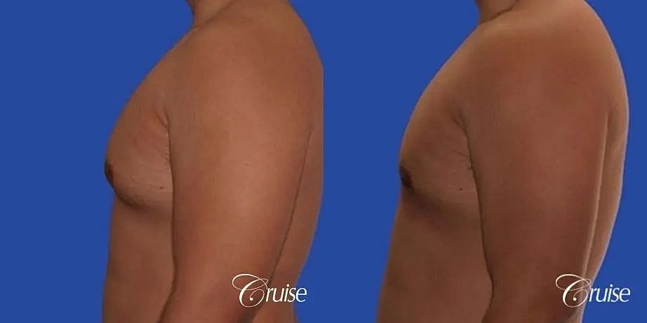 Gynecomastia Before & After