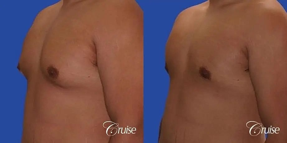 Gynecomastia Before & After