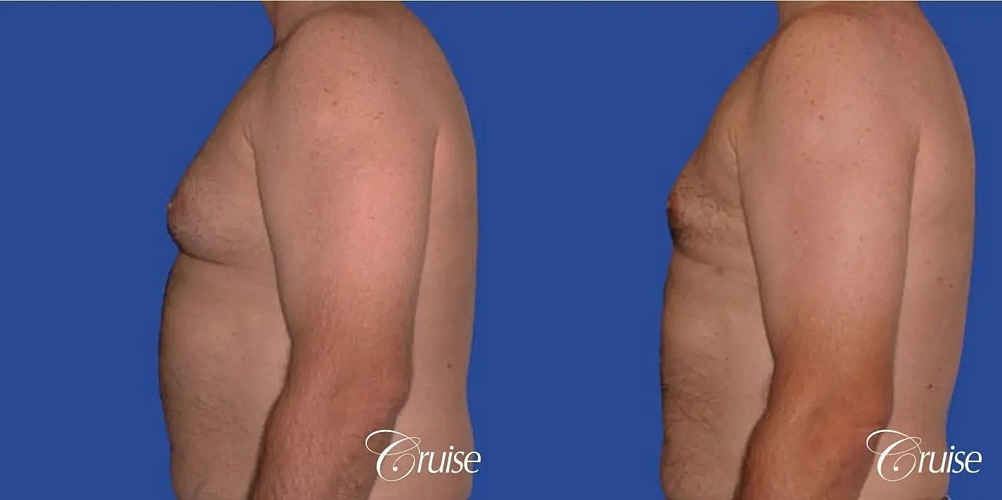 Gynecomastia Before & After