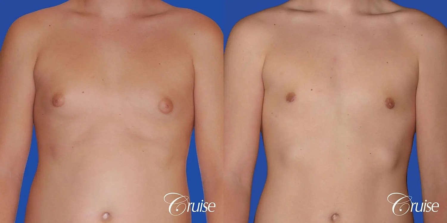 Gynecomastia Before & After