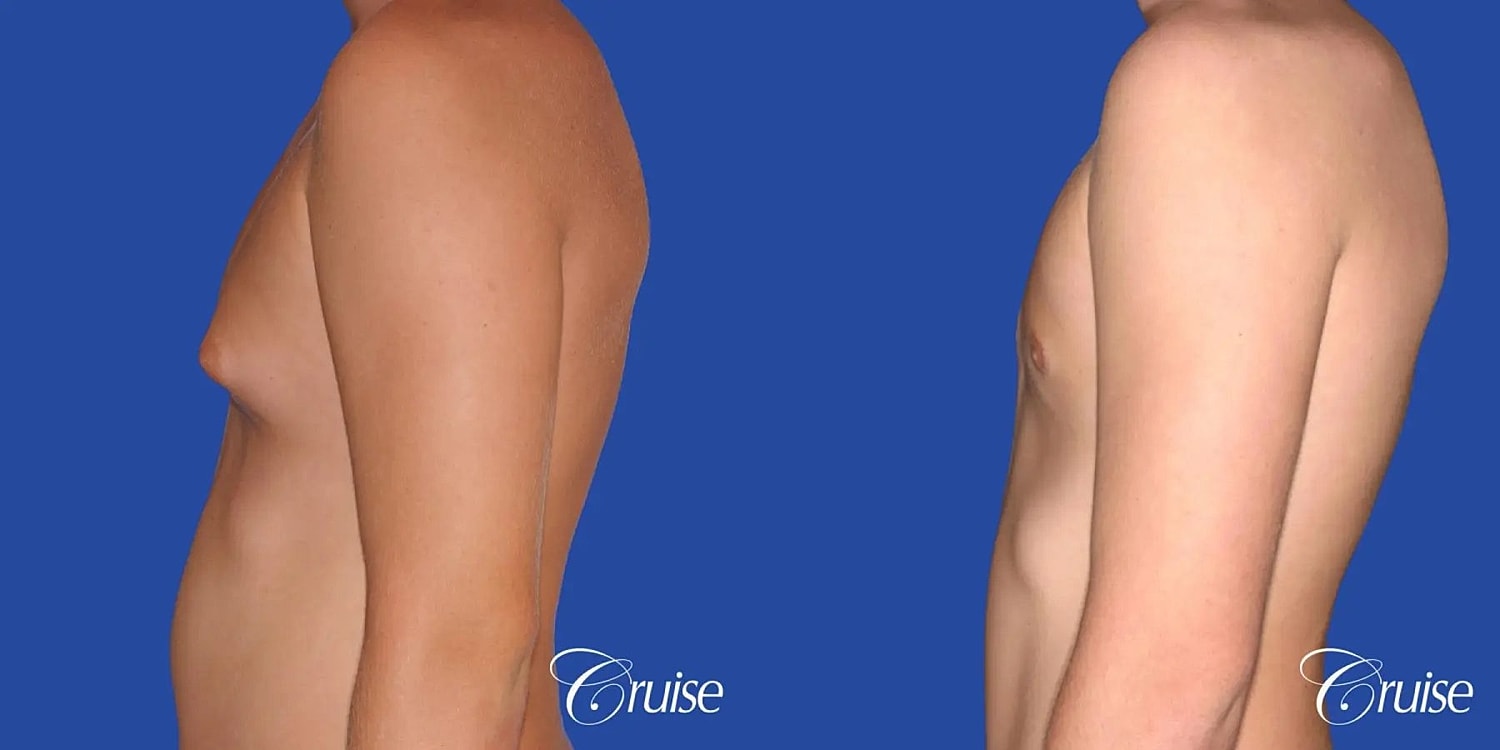Gynecomastia Before & After