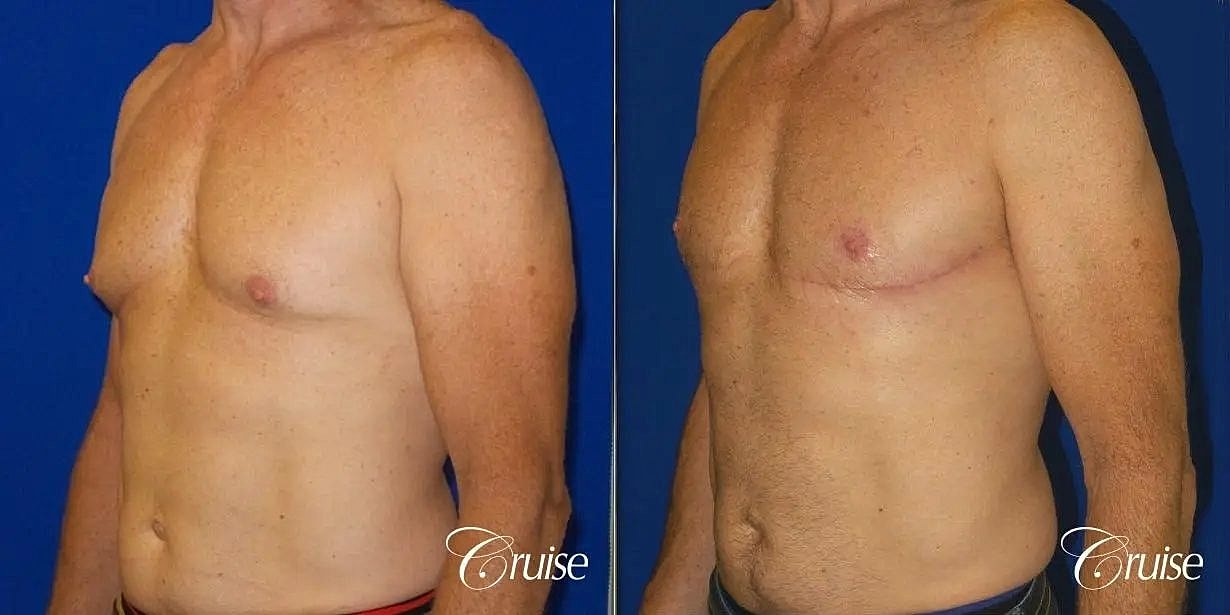 Gynecomastia Before & After