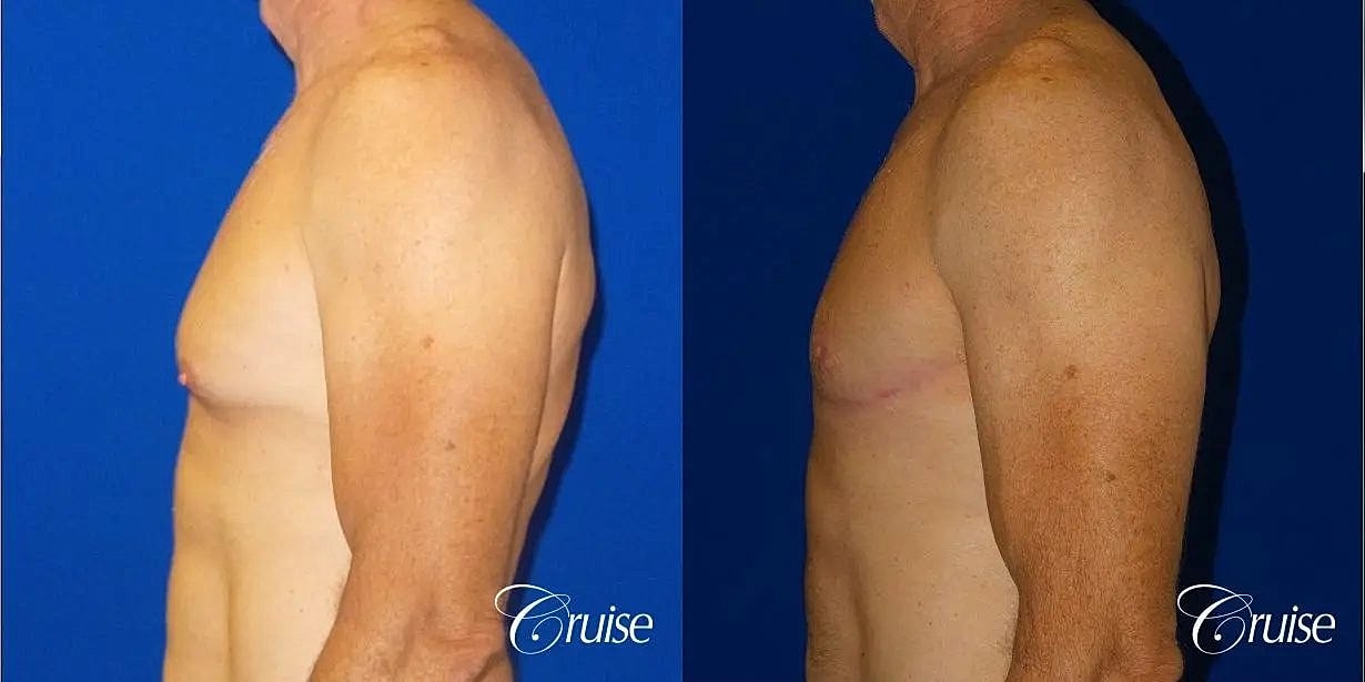 Gynecomastia Before & After