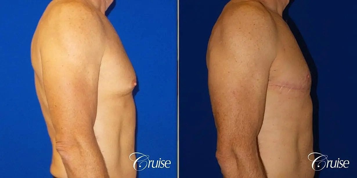 Gynecomastia Before & After