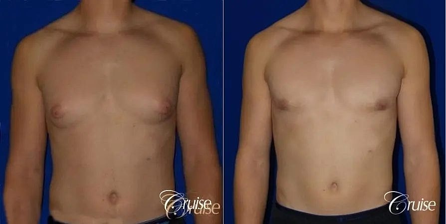 Gynecomastia Before & After