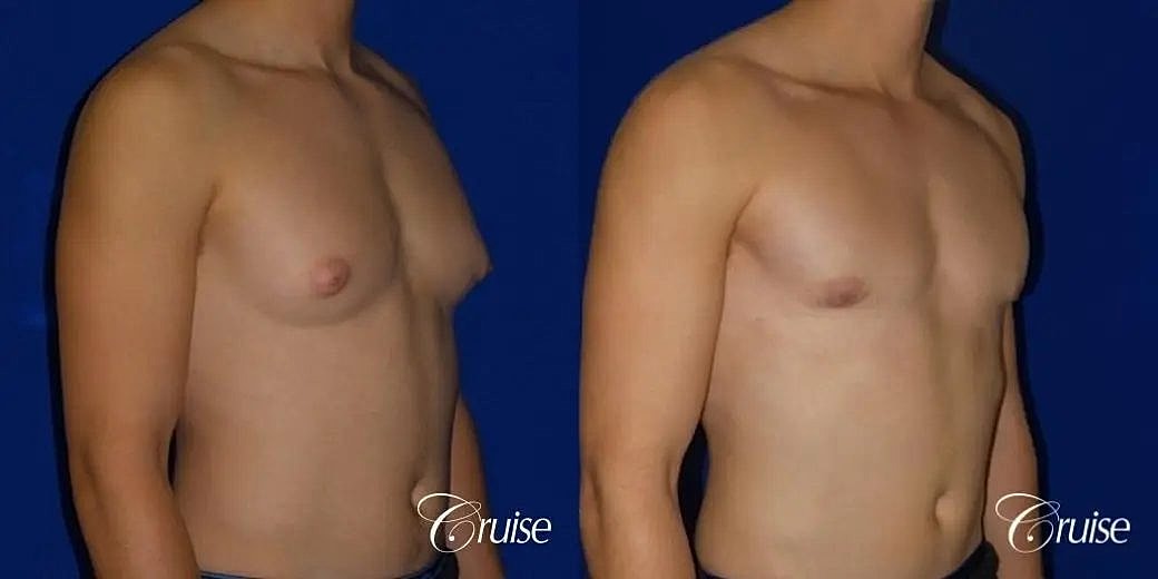 Gynecomastia Before & After