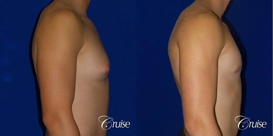 Gynecomastia Before & After
