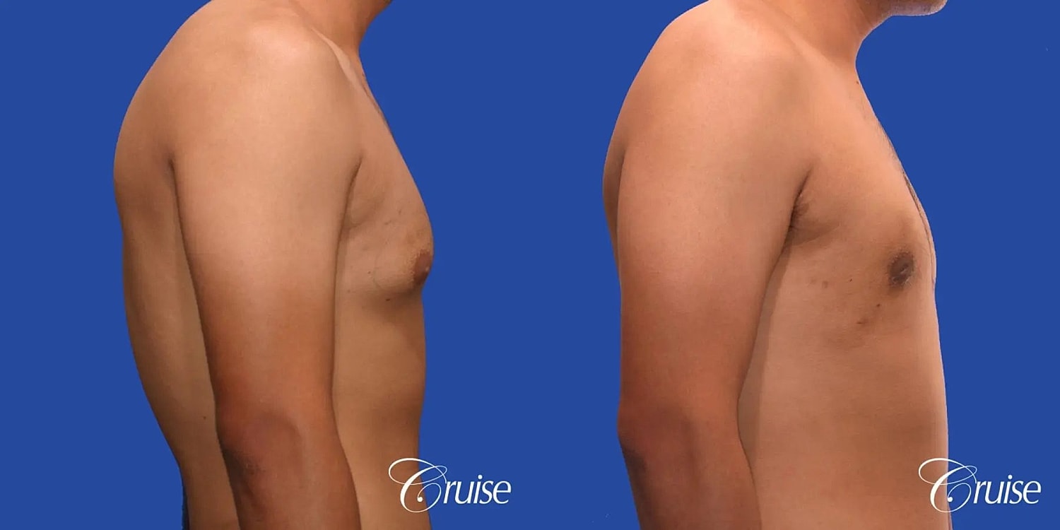 Gynecomastia Before & After