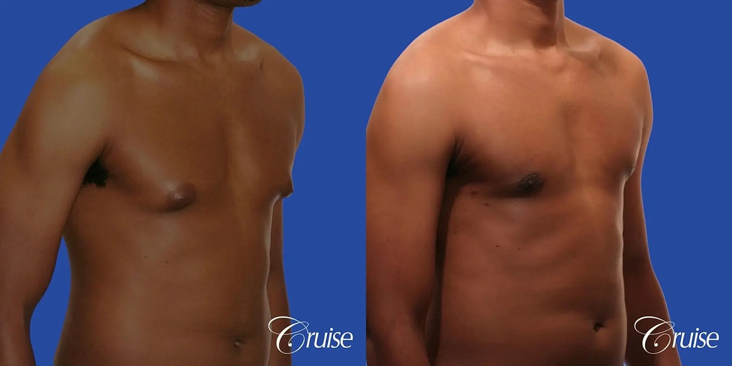 Gynecomastia Before & After