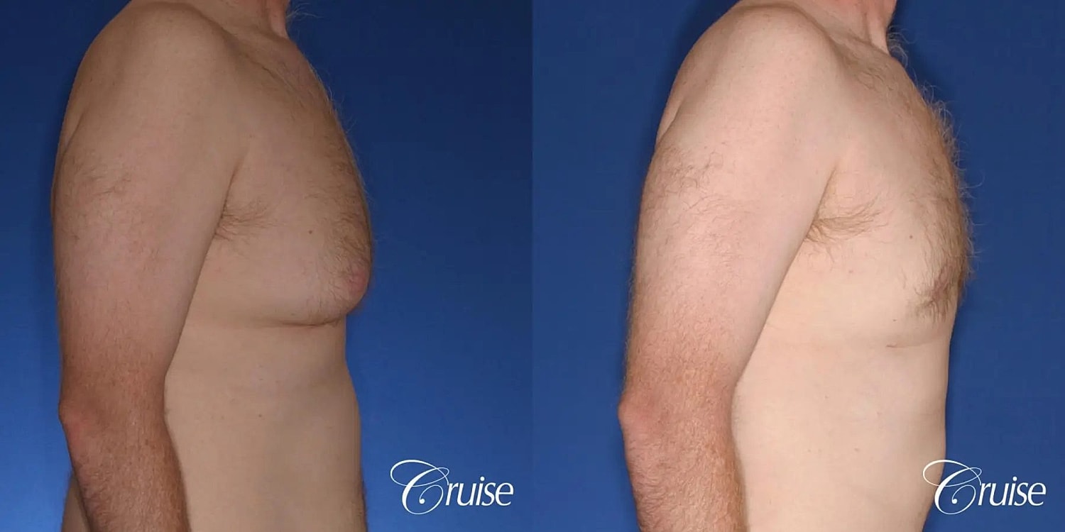 Gynecomastia Before & After