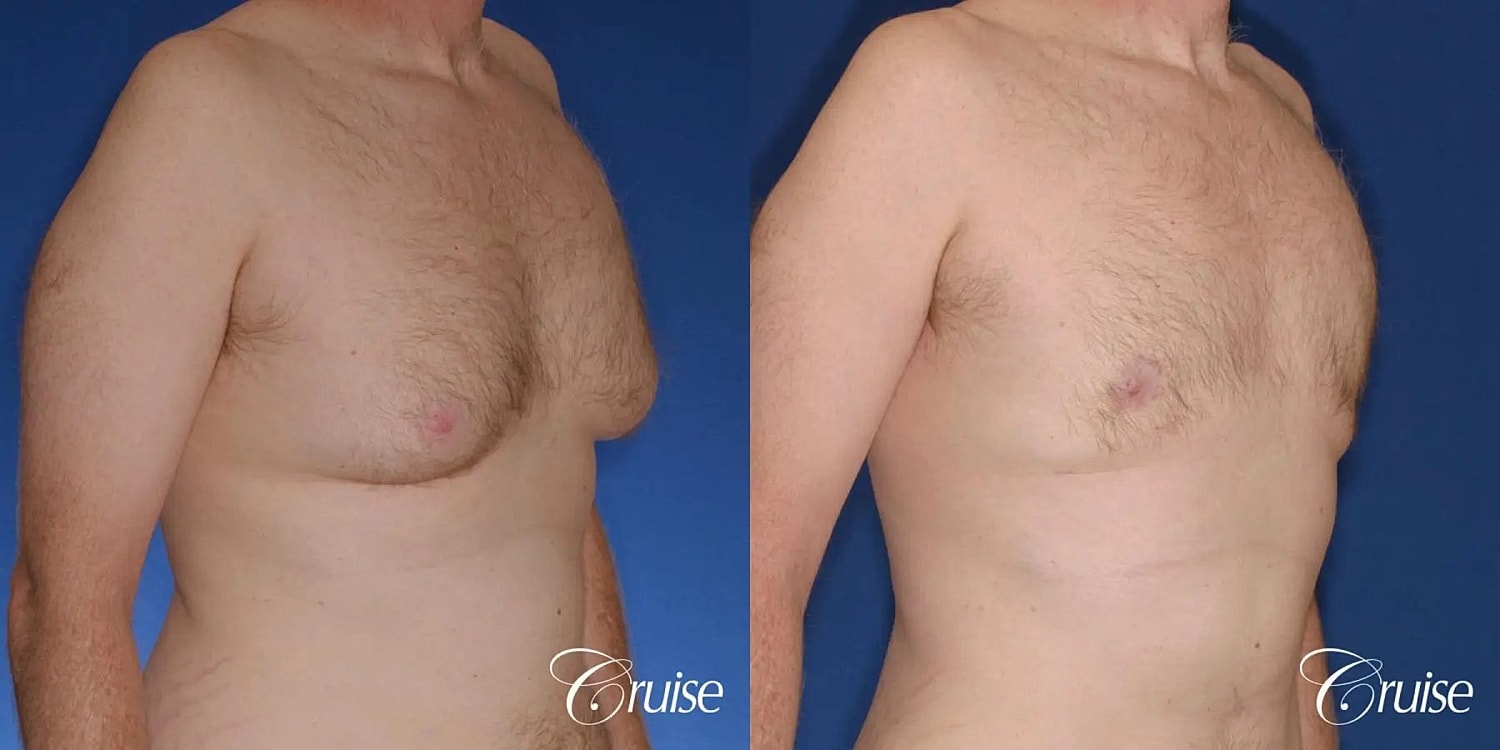 Gynecomastia Before & After