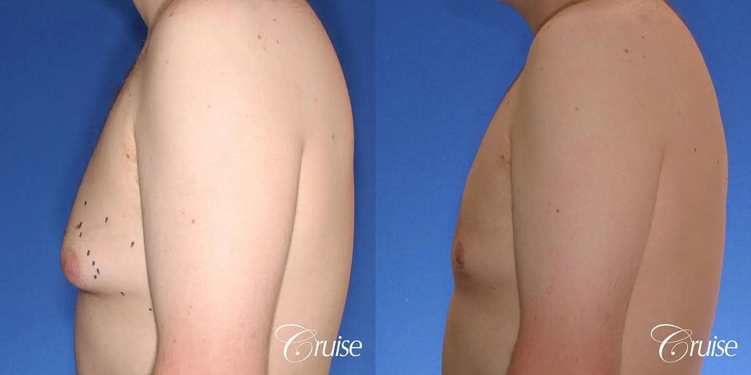 Gynecomastia Before & After