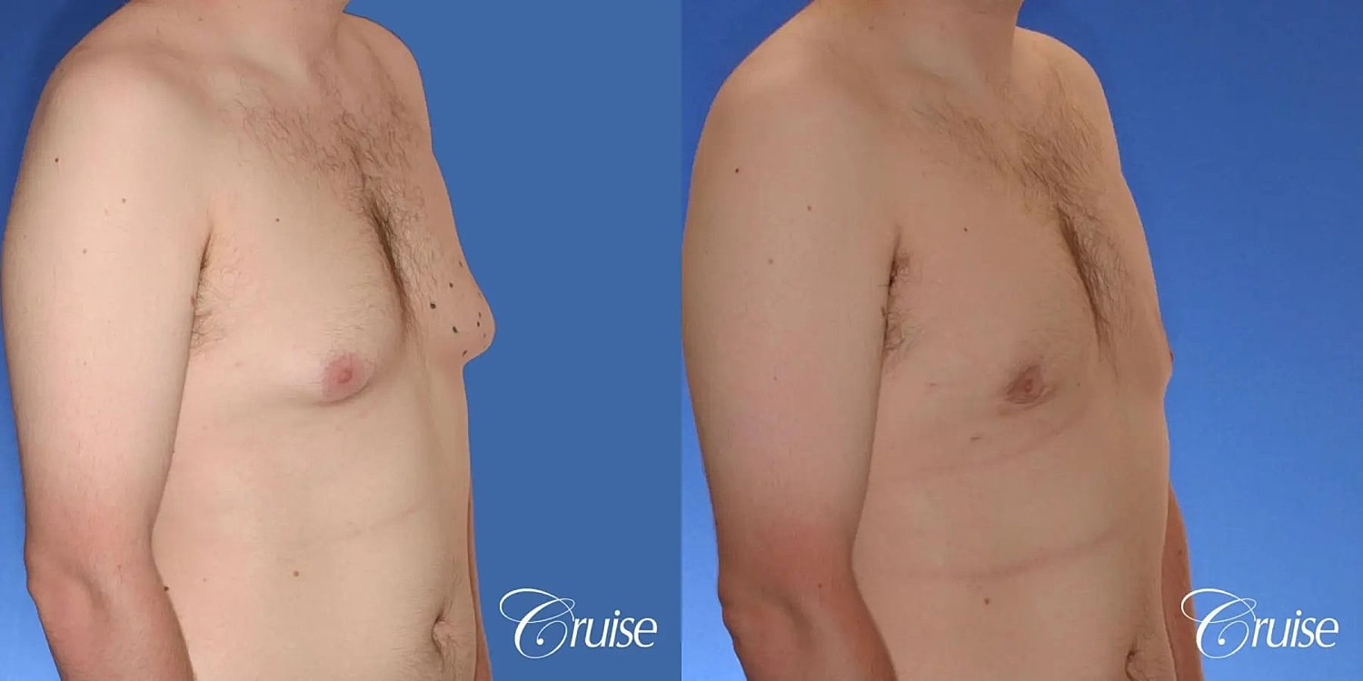 Gynecomastia Before & After