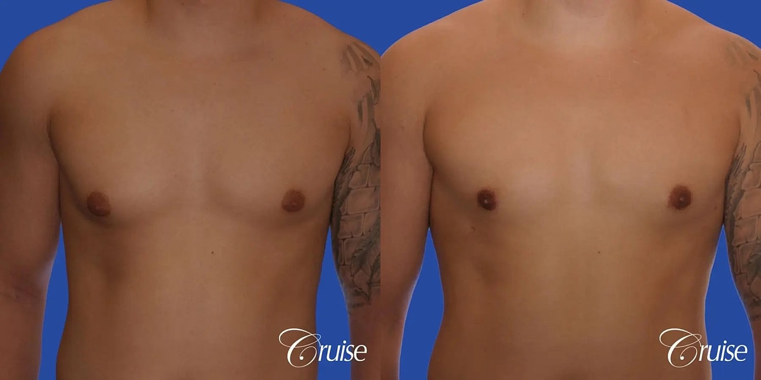 Gynecomastia Before & After