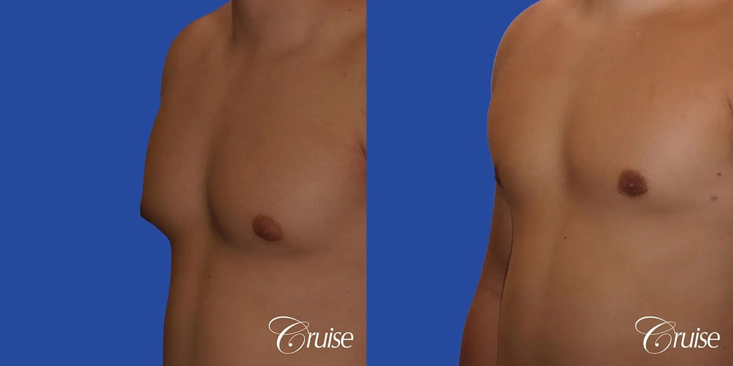 Gynecomastia Before & After