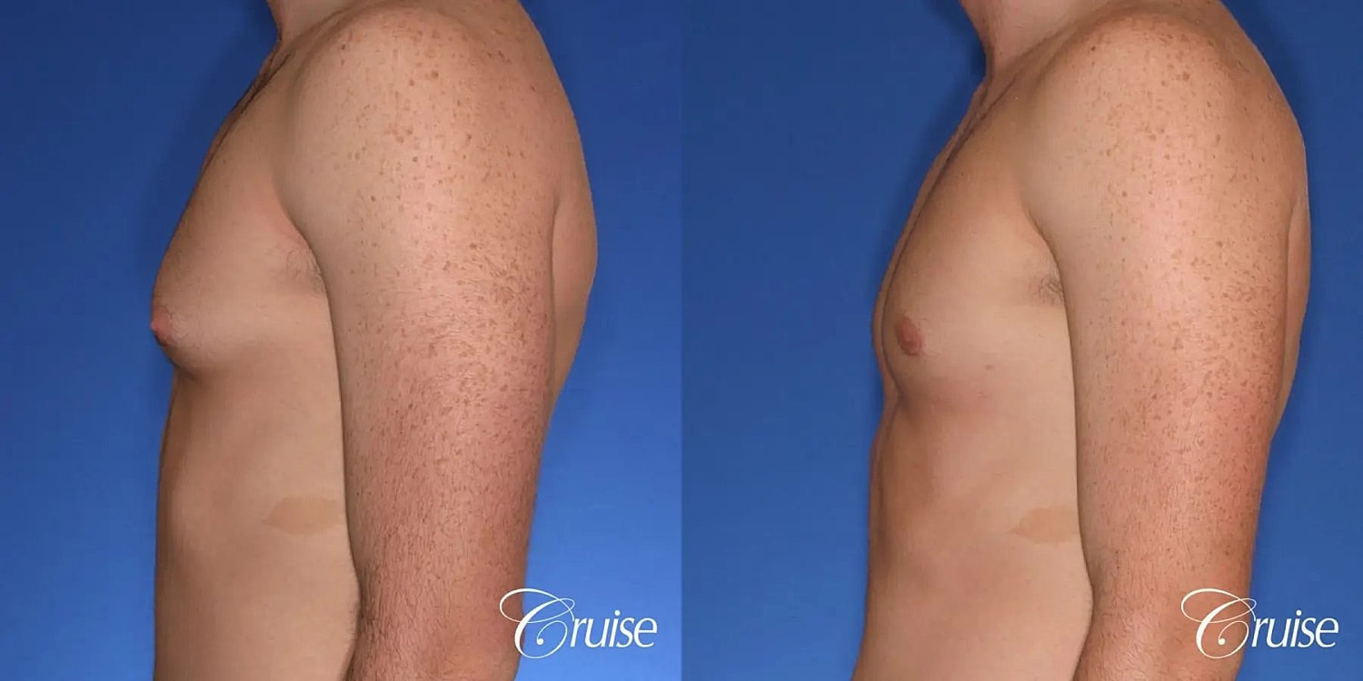 Gynecomastia Before & After