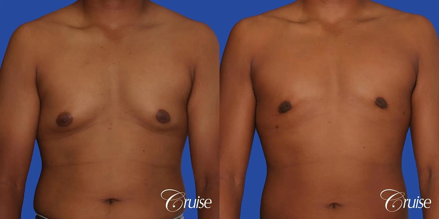 Gynecomastia Before & After