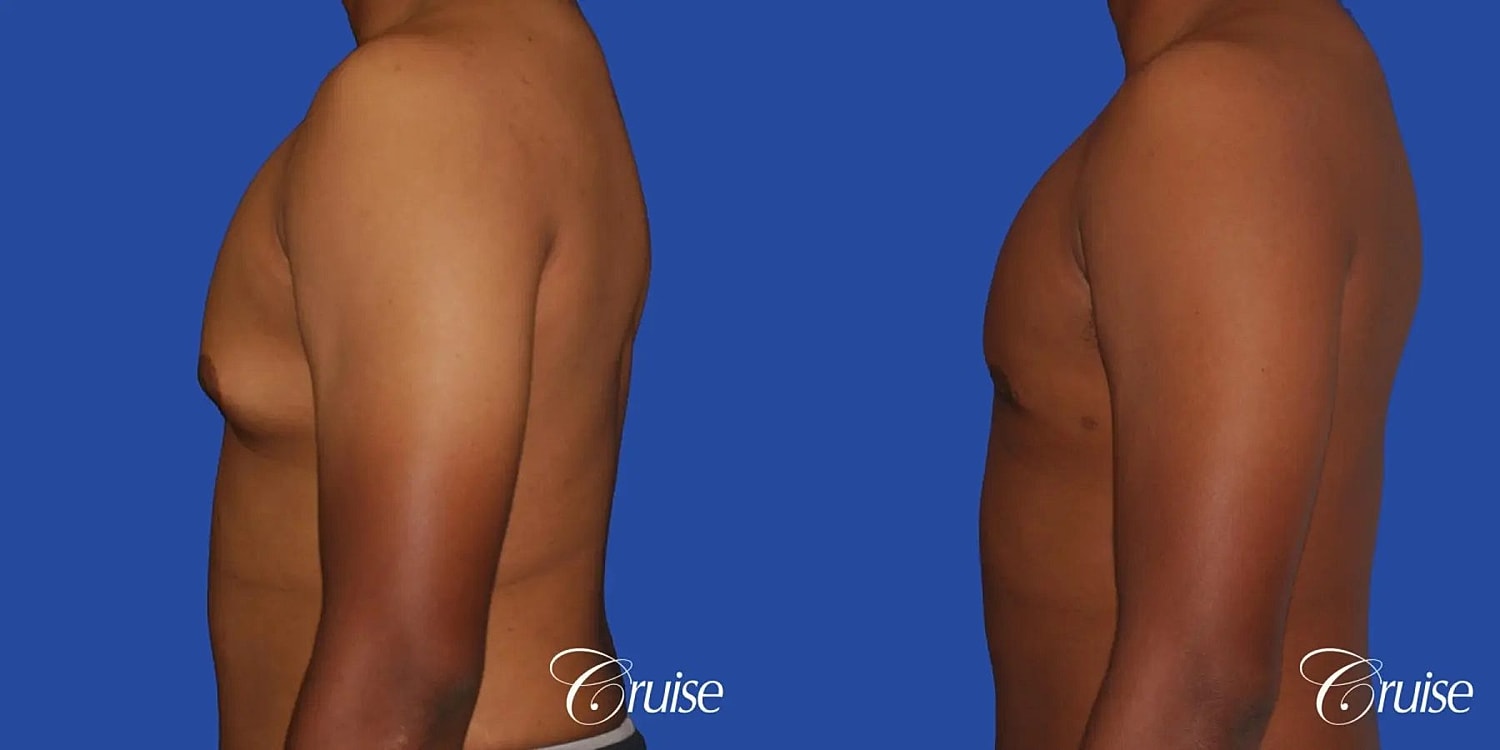 Gynecomastia Before & After