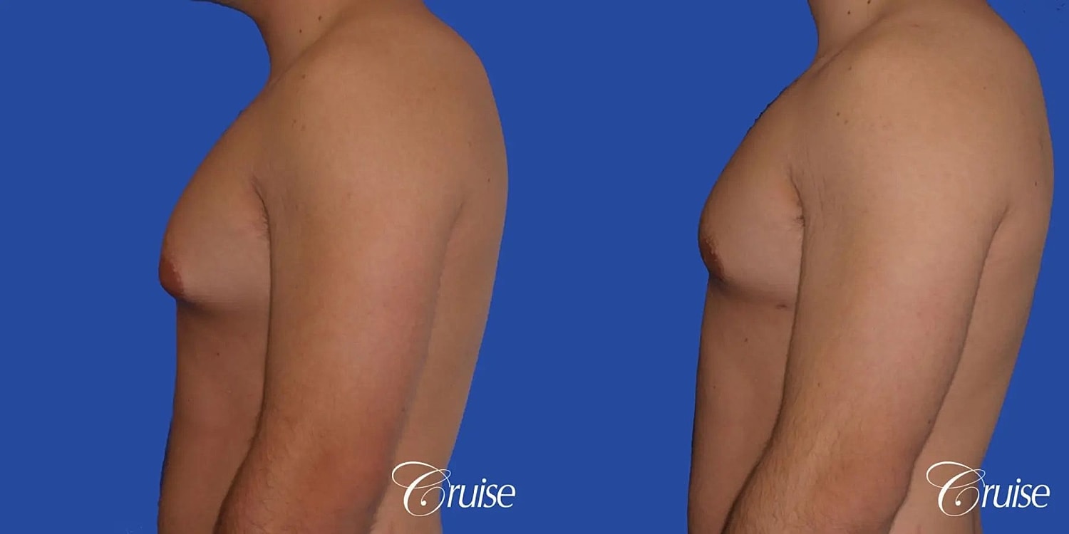 Gynecomastia Before & After