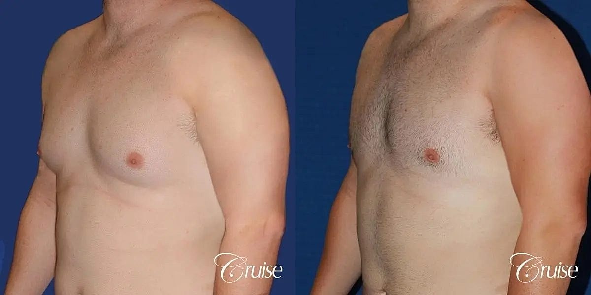 Gynecomastia Before & After