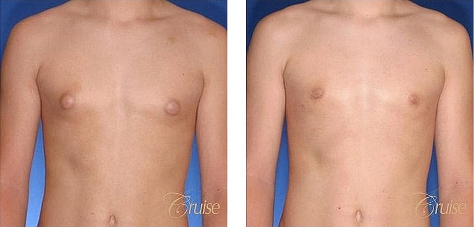 Before and after body contouring results.