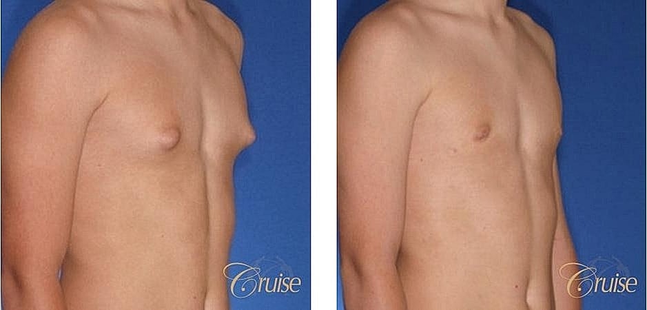 Before and after chest contouring procedure