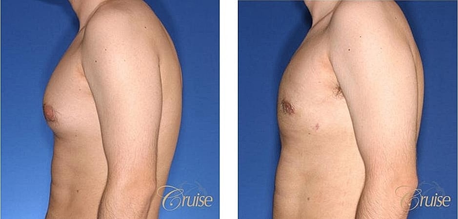 Before and after male chest transformation images