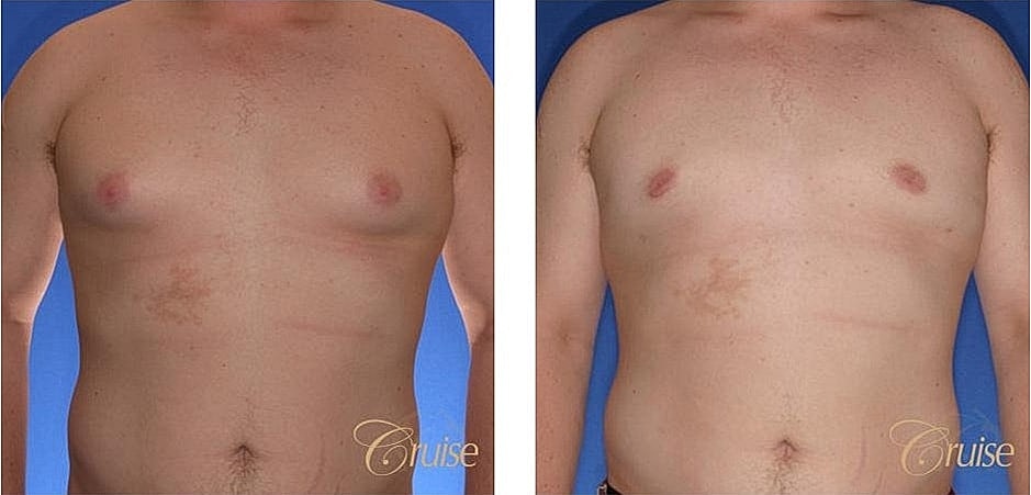 Before and after chest results comparison.