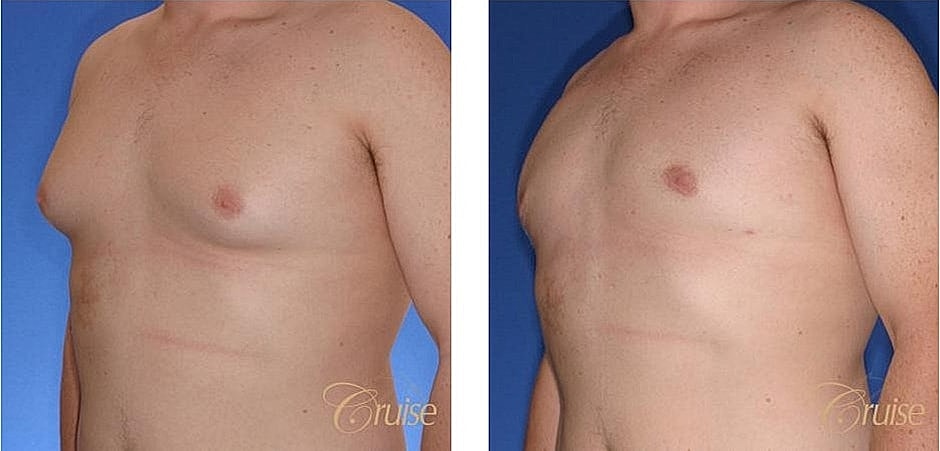 Before and after chest surgery comparison.