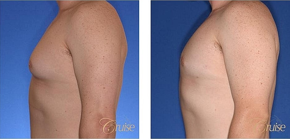 Before and after images of male chest surgery.
