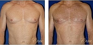 Before and after male chest comparison images.