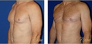 Before and after male chest comparison