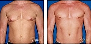 Before and after chest appearance transformation