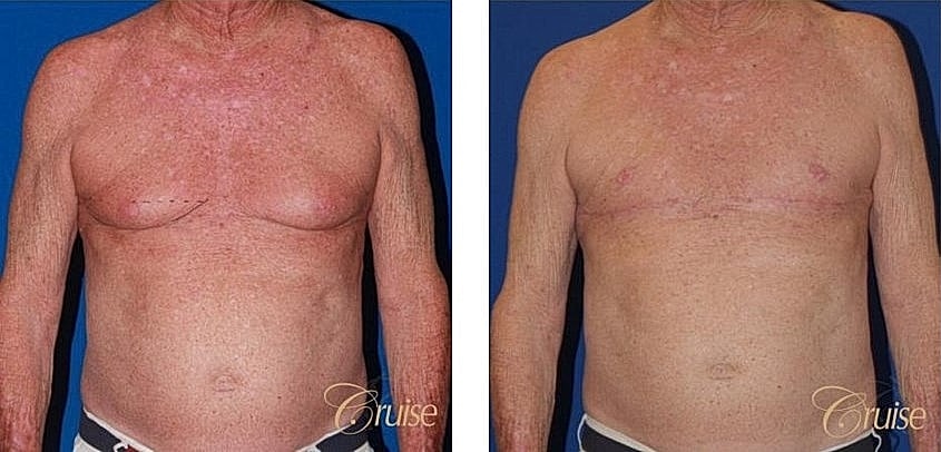 Post-surgical chest transformation before and after.