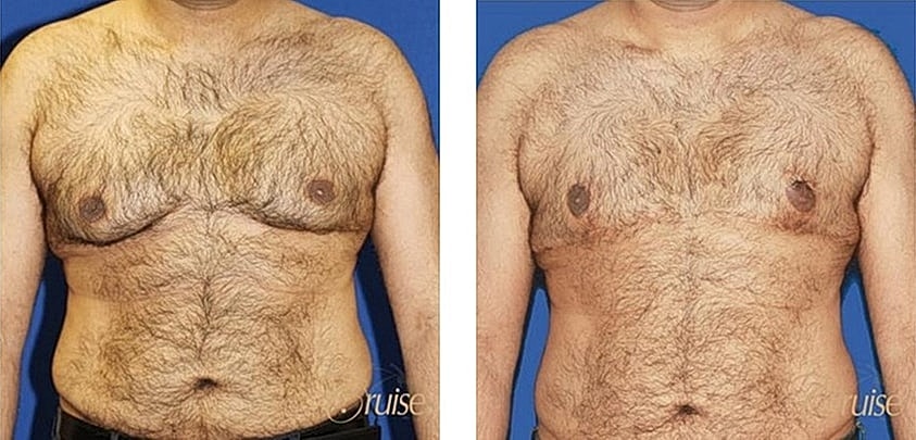Before and after male chest photos.