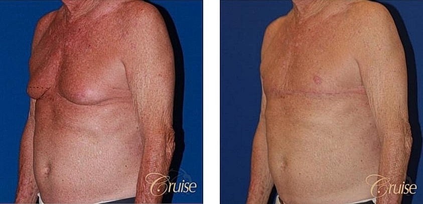 Before and after chest procedure comparison.