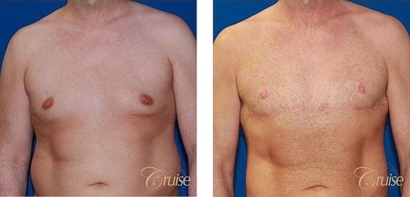 Before and after chest transformation photos.