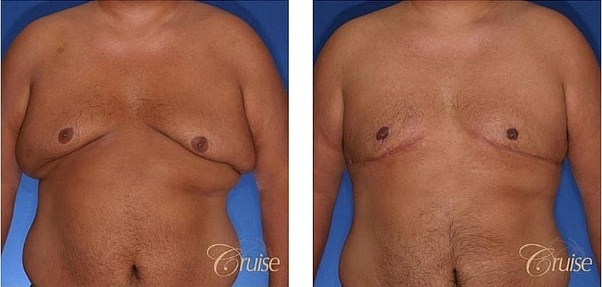 Before and after male breast reduction surgery.