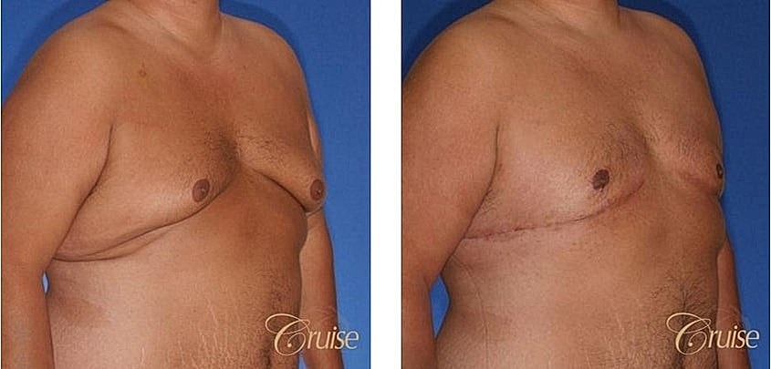 Before and after body contouring procedure images.
