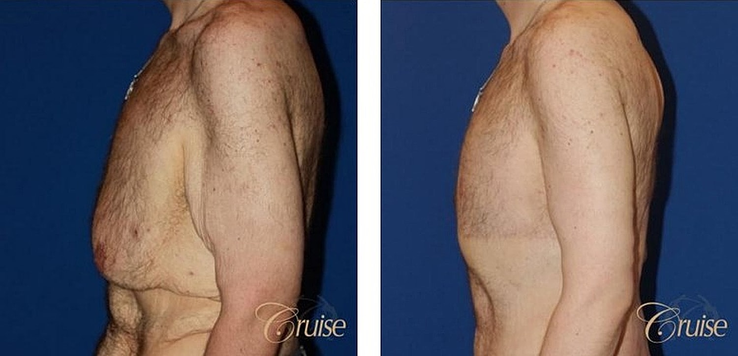 Before and after body transformation comparison image.