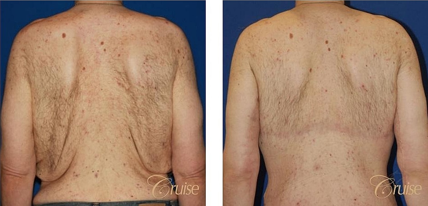 Before and after back skin treatment comparison.