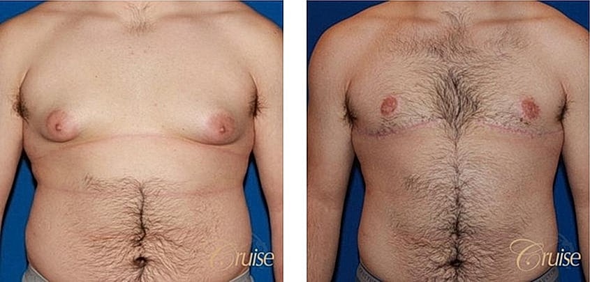 Before and after body contouring procedure comparison.
