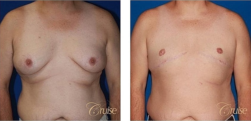 Before and after male chest surgery comparison.