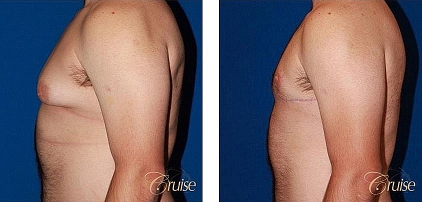 Side-by-side comparison of male chest transformation.