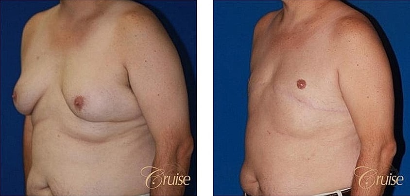 Before and after male chest surgery images.