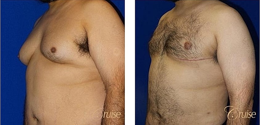 Before and after male chest transformation.
