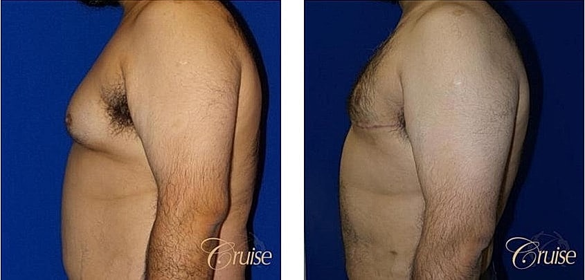 Before and after body transformation comparison.